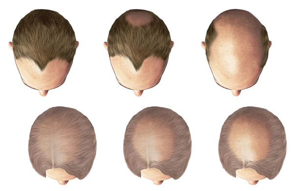 Erkek Tipi Saç Dökülmesinde Genetiğin Etkisi